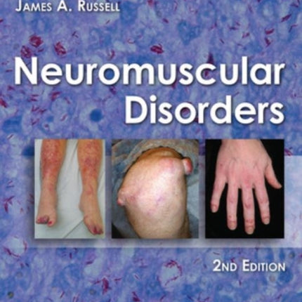 Neuromuscular Disorders