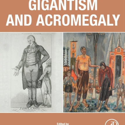 Gigantism and Acromegaly