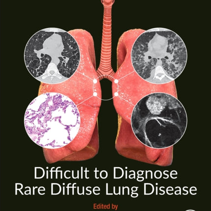 Difficult to Diagnose Rare Diffuse Lung Disease