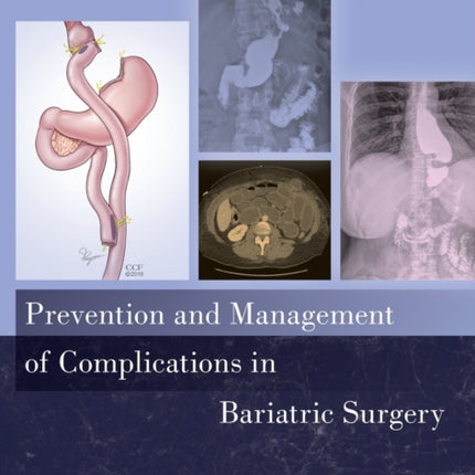 Prevention and Management of Complications in Bariatric Surgery