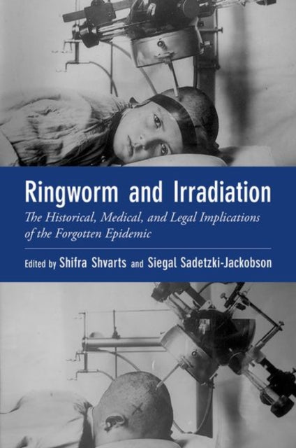 Ringworm and Irradiation