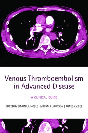 Venous Thromboembolism in Advanced Disease: A clinical guide