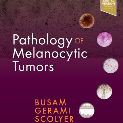 Pathology of Melanocytic Tumors