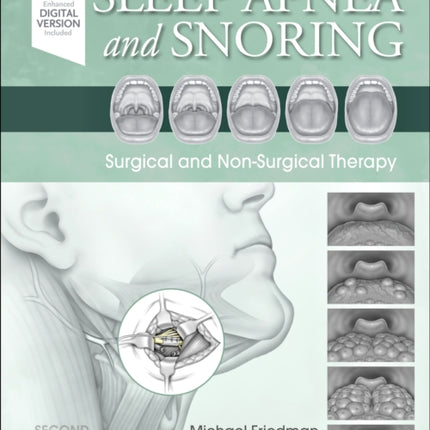 Sleep Apnea and Snoring: Surgical and Non-Surgical Therapy