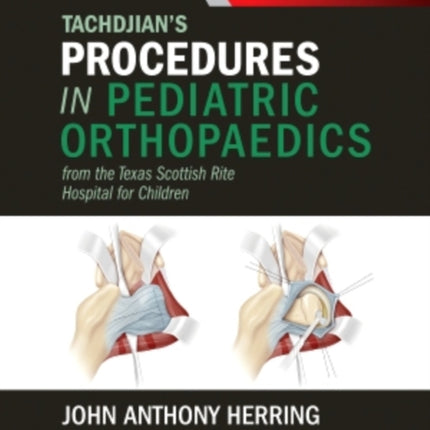 Tachdjian's Procedures in Pediatric Orthopaedics: From the Texas Scottish Rite Hospital for Children