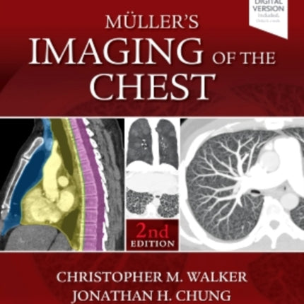 Muller's Imaging of the Chest: Expert Radiology Series