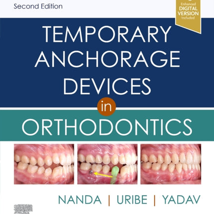 Temporary Anchorage Devices in Orthodontics