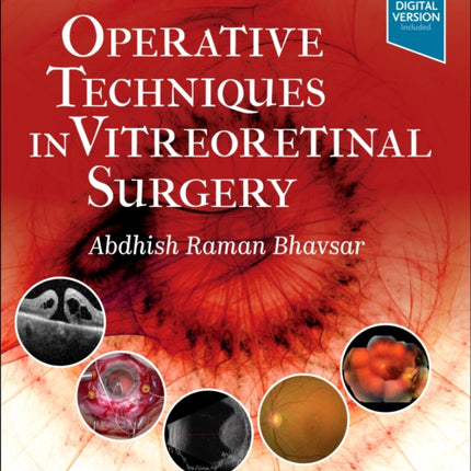 Operative Techniques in Vitreoretinal Surgery