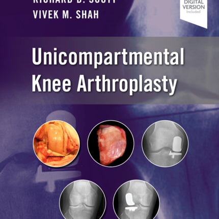 Unicompartmental Knee Arthroplasty