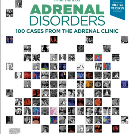 Adrenal Disorders: 100 Cases from the Adrenal Clinic