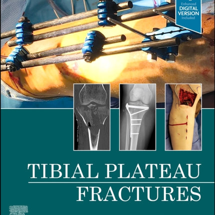 Tibial Plateau Fractures