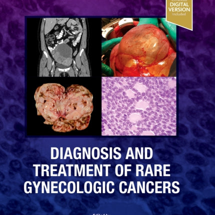 Diagnosis and Treatment of Rare Gynecologic Cancers