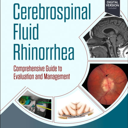 Cerebrospinal Fluid Rhinorrhea: Comprehensive Guide to Evaluation and Management