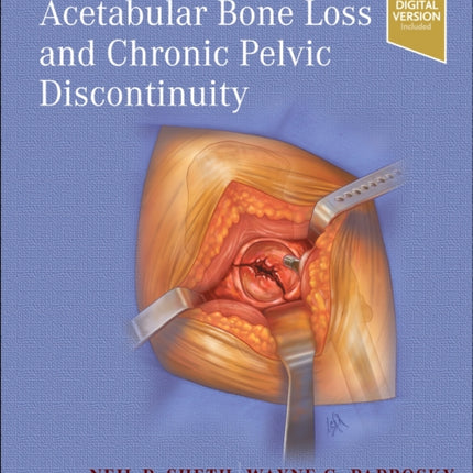 Treatment of Acetabular Bone Loss and Chronic Pelvic Discontinuity