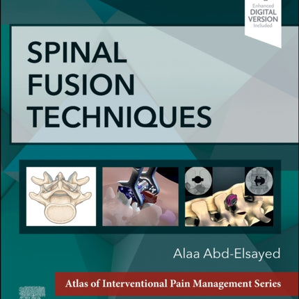 Spinal Fusion Techniques