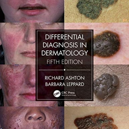 Differential Diagnosis in Dermatology