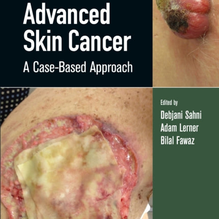 Advanced Skin Cancer