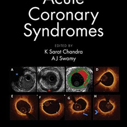 Acute Coronary Syndromes