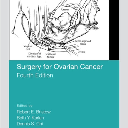 Surgery for Ovarian Cancer