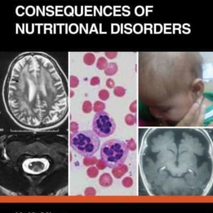 Neurological Consequences of Nutritional Disorders