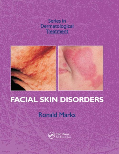 Facial Skin Disorders Series in Dermatological