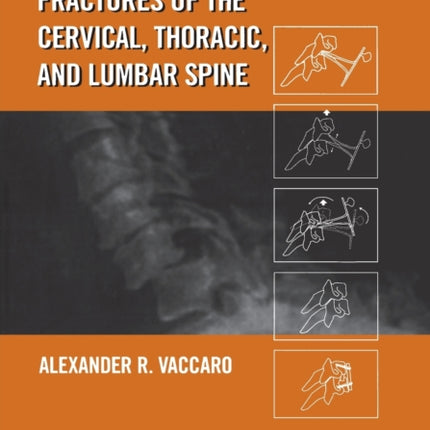 Fractures of the Cervical Thoracic and Lumbar Spine
