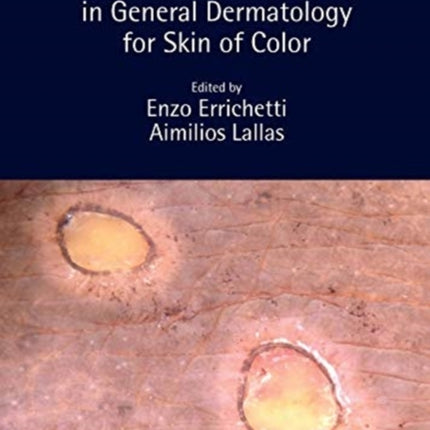 Dermoscopy in General Dermatology for Skin of Color