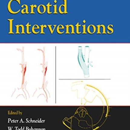 Carotid Interventions