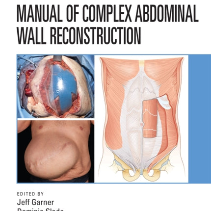 Manual of Complex Abdominal Wall Reconstruction