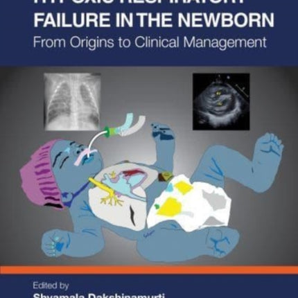 Hypoxic Respiratory Failure in the Newborn