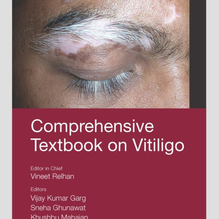 Comprehensive Textbook on Vitiligo