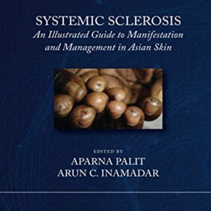 Systemic Sclerosis