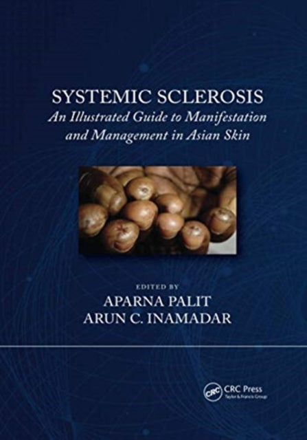 Systemic Sclerosis