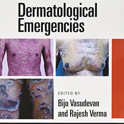 Dermatological Emergencies