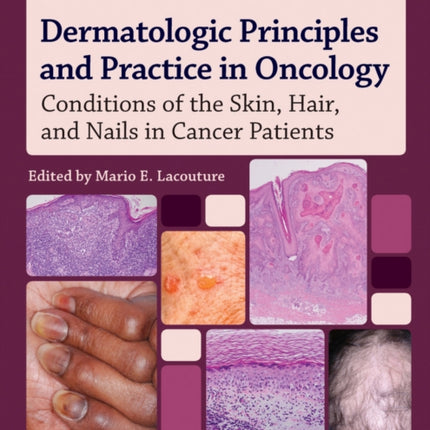 Dermatologic Principles and Practice in Oncology: Conditions of the Skin, Hair, and Nails in Cancer Patients