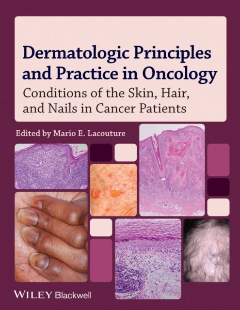 Dermatologic Principles and Practice in Oncology: Conditions of the Skin, Hair, and Nails in Cancer Patients