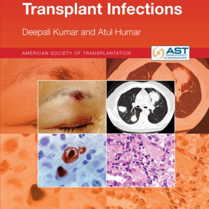The AST Handbook of Transplant Infections