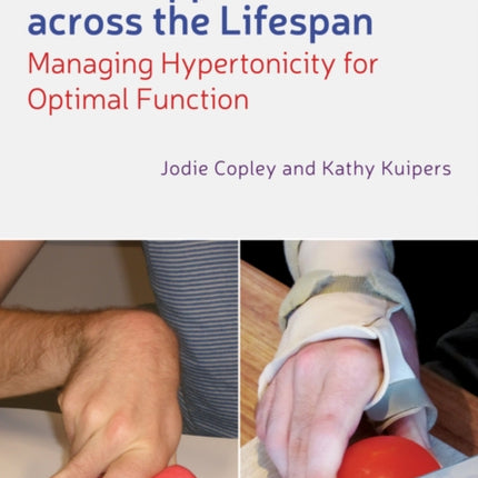 Neurorehabilitation of the Upper Limb Across the Lifespan: Managing Hypertonicity for Optimal Function