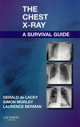 The Chest X-Ray: A Survival Guide