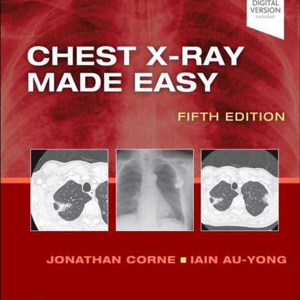 Chest X-Ray Made Easy