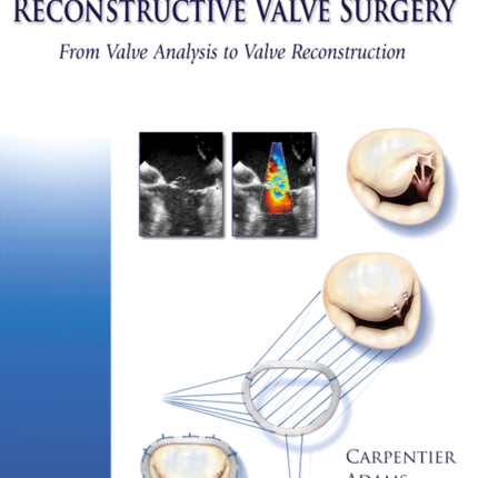 Carpentier's Reconstructive Valve Surgery