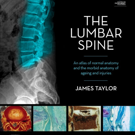 The Lumbar Spine: An Atlas of Normal Anatomy and the Morbid Anatomy of Ageing and Injury