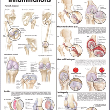Hip and Knee Inflammations Anatomical Chart