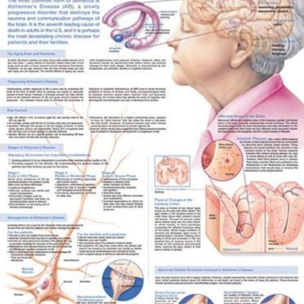 Understanding Alzheimers Disease Anatomical Chart