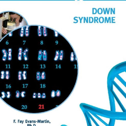 Down Syndrome
