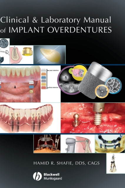 Clinical and Laboratory Manual of Implant Overdentures