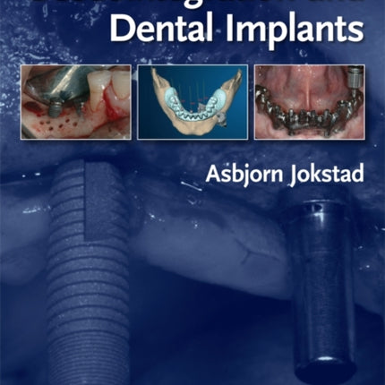 Osseointegration and Dental Implants