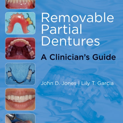 Removable Partial Dentures: A Clinician's Guide