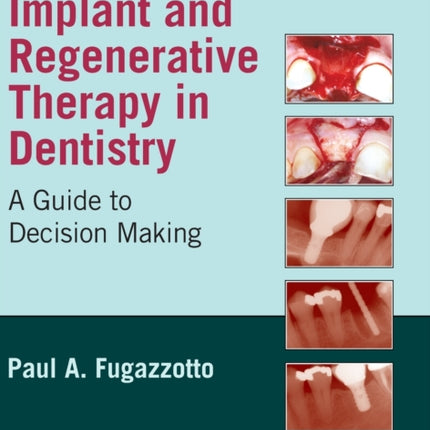 Implant and Regenerative Therapy in Dentistry: A Guide to Decision Making