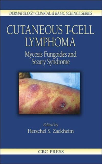 Cutaneous T-Cell Lymphoma: Mycosis Fungoides and Sezary Syndrome